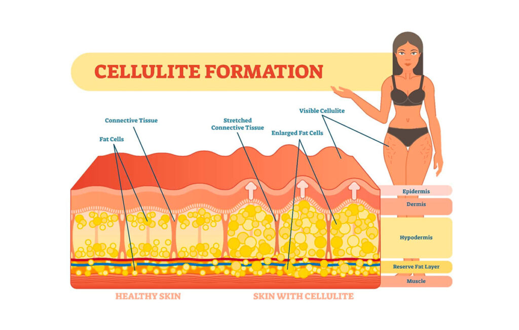 Cellulite: cos'è e come si forma
