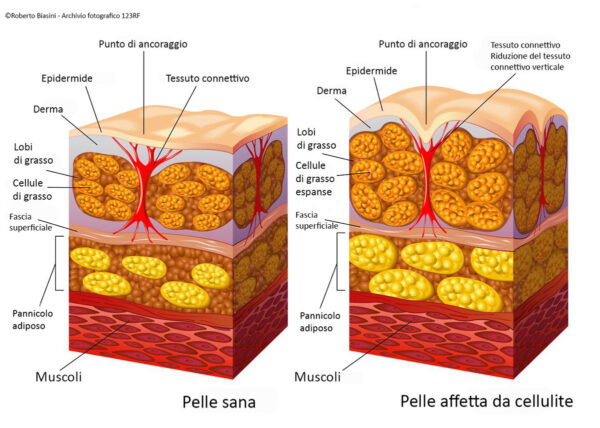 Fig. 2 Formazione della cellulite